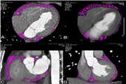 Assessing the Relation of Epicardial Fat Thickness and Volume, Quantified by 256-Slice Computed Tomography Scan, With Coronary Artery Disease and Cardiovascular Risk Factors